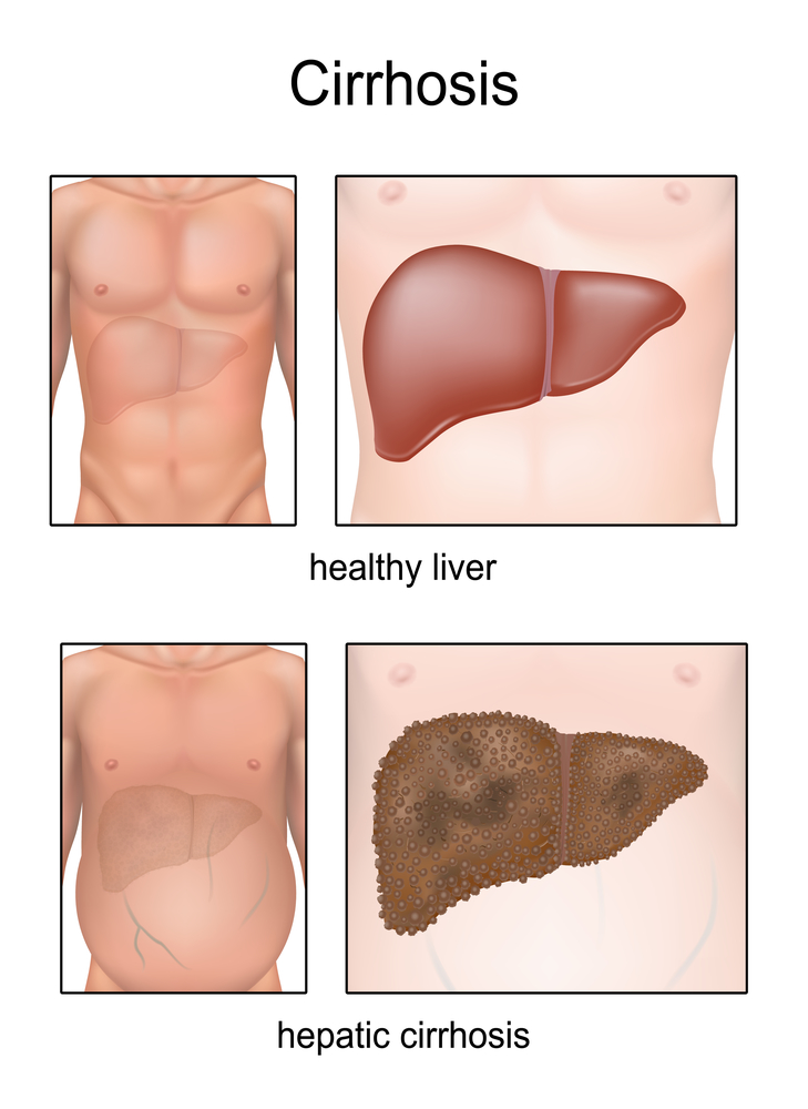 Know about the signs of liver damage before you develop cirrhosis of the liver.