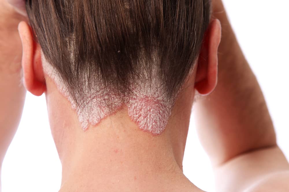 Psoriasis can occur anywhere on your body.