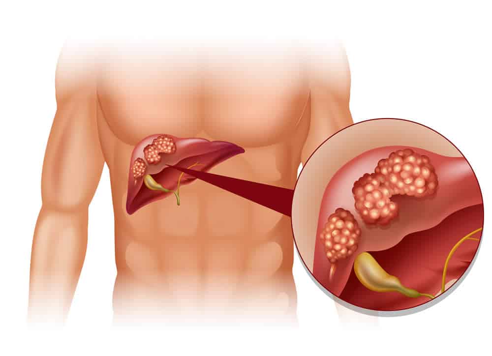 Can liver cysts develop into liver cancer?