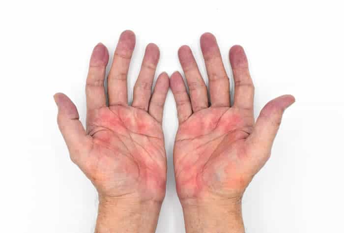 Palmar erythema is a fatty liver disease symptom.