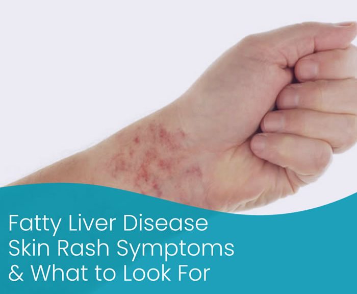 Fatty Liver Disease Skin Rash Symptoms & What to Look For